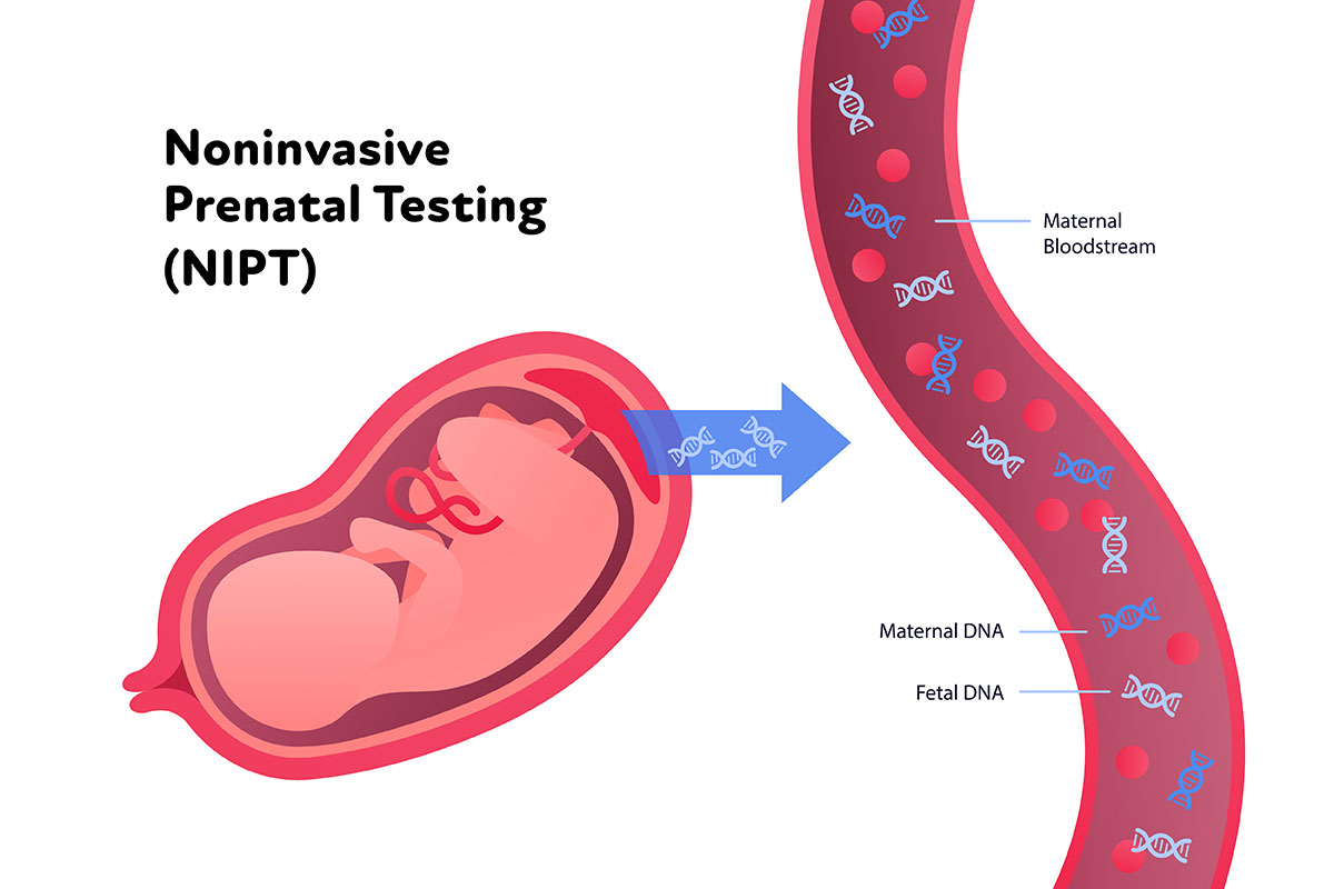 NIPT